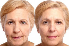 Photo 3 before and after application of Goji Cream