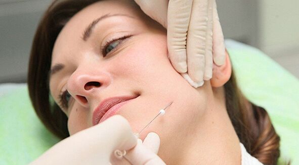 Thread lifting - a method of cosmetic rejuvenation of the face after 45 years