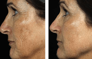 Before and after fractional facial rejuvenation