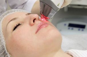 Facial skin rejuvenation process with fractional laser