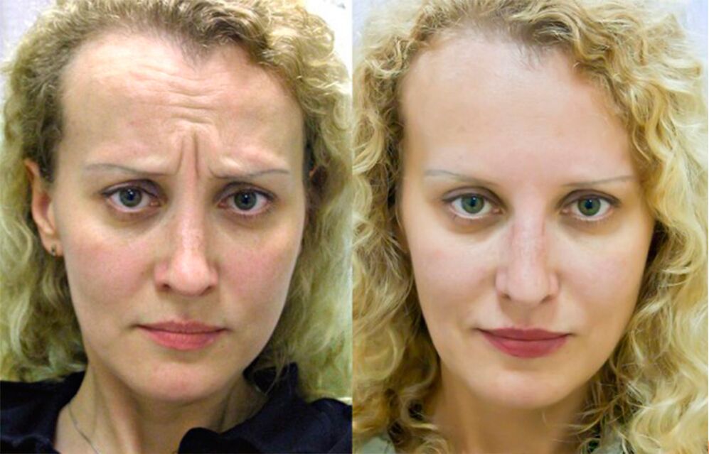 before and after using the massager for rejuvenation ltza photo 1