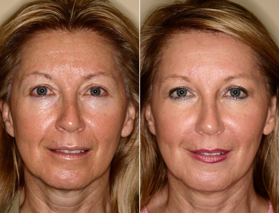before and after using the massager for rejuvenation ltza photo 5