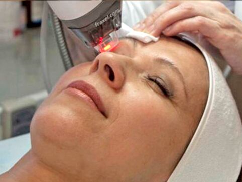 laser rejuvenation of the skin around the eyes