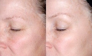 rejuvenation of the skin around the eyes before and after photos