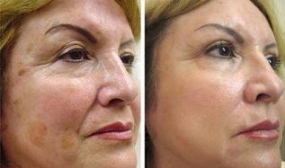 fractional skin rejuvenation before and after photos