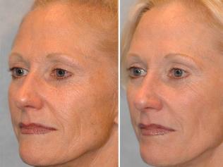 Before and after microcurrent therapy