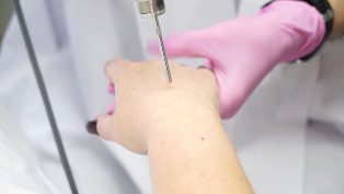 Laser rejuvenation of hand skin