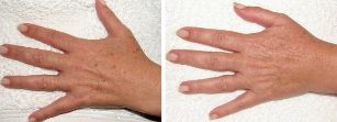 The result of removing age spots on the hands