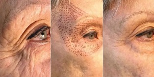 photos before and after plasma skin rejuvenation